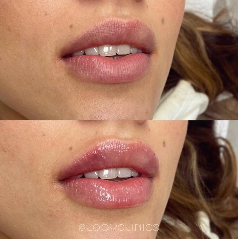 Lipfillers voor en na