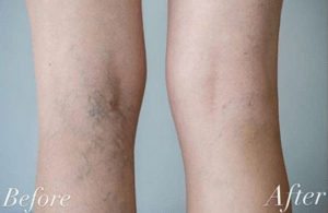 Spataderen voor en na