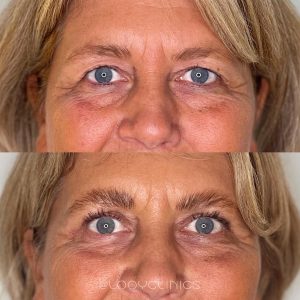 Ooglidcorrectie resultaat