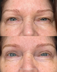 Hangende oogleden resultaat voor en na