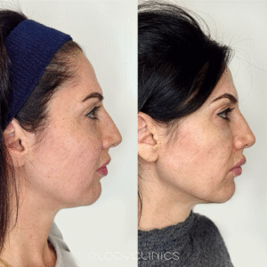 Fillers voor de kaaklijn